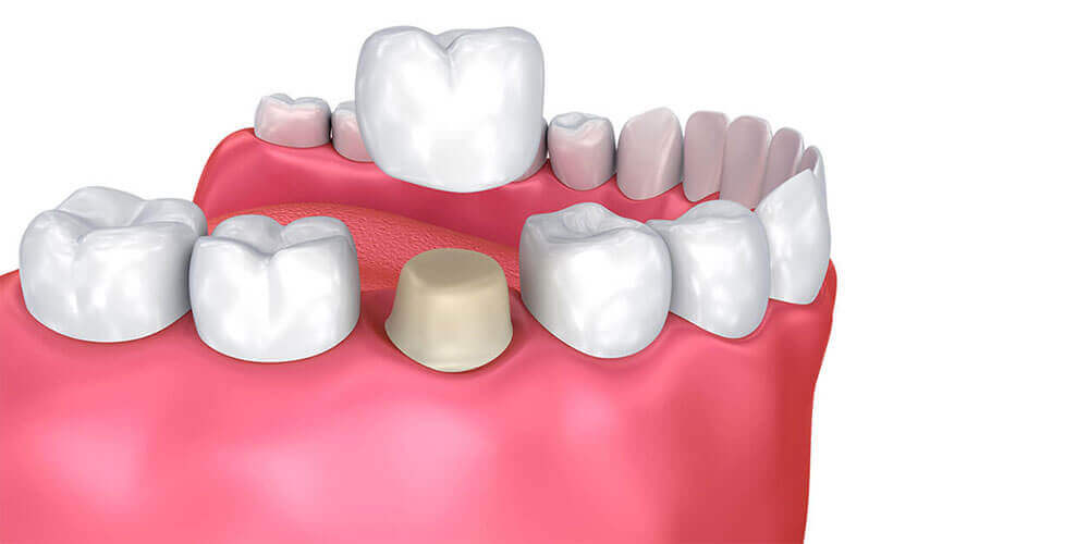 Dental Crowns Edmonton