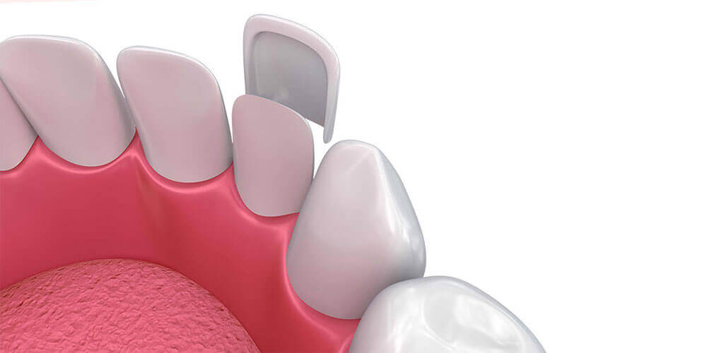 Dental Veneers Edmonton